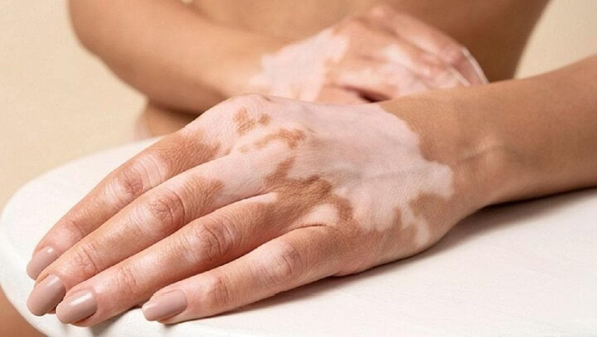 تازه‌ترین توصیه‌های پزشکی برای کنترل لک‌های پوستی