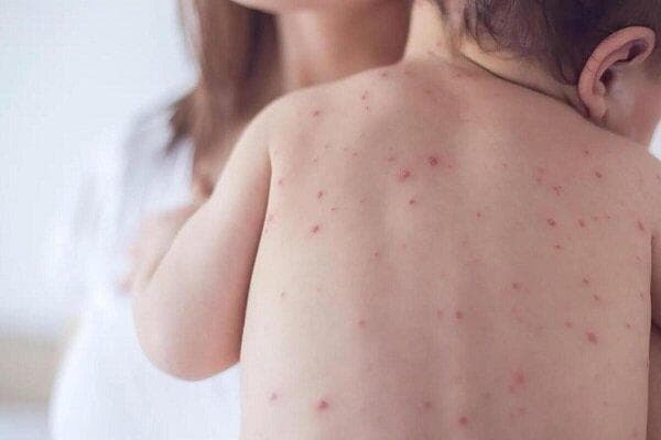 عوارض و علائم خطرناک ابتلا به آبله مرغان در بزرگسالی