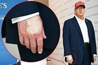 آیا رئیس‌جمهور آمریکا جذام گرفته است؟