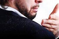 شوره سر از علایم کمبود ویتامین ها در بدن است