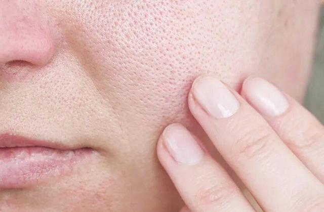 با منافذ باز پوست چه کنیم؟/ این منافذ به طور قطعی درمان می‌شوند؟