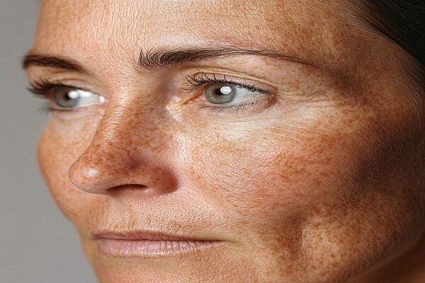 با منافذ باز پوست چه کنیم؟
