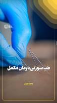 طب سوزنی درمان مکمل