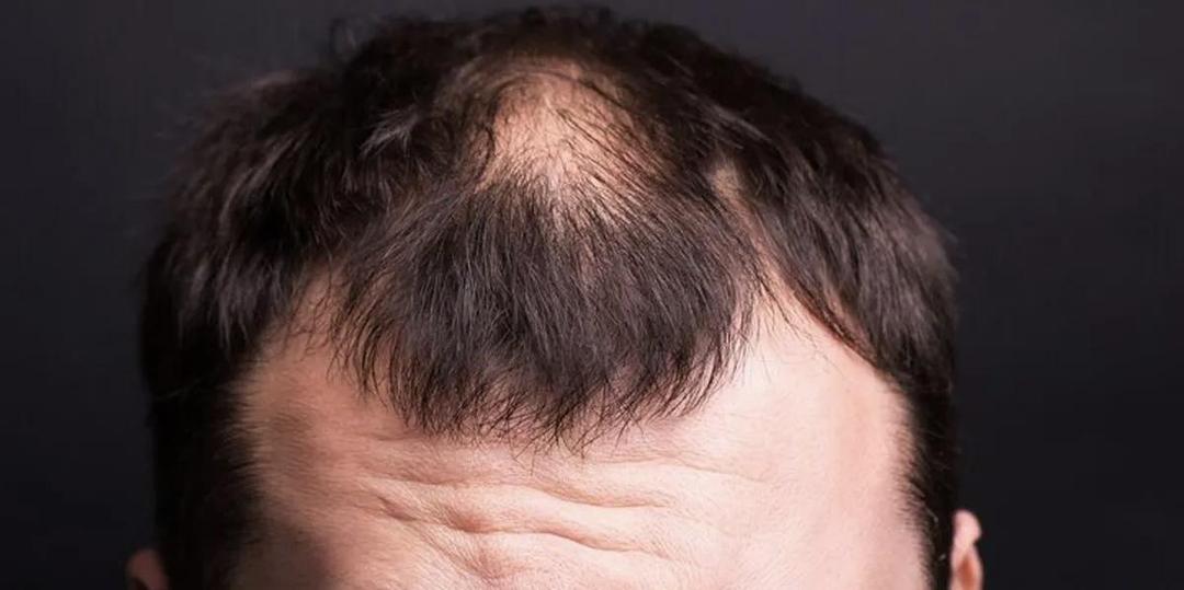 طاسی ارثی معمولاً از چه سنی آغاز می‌شود؟