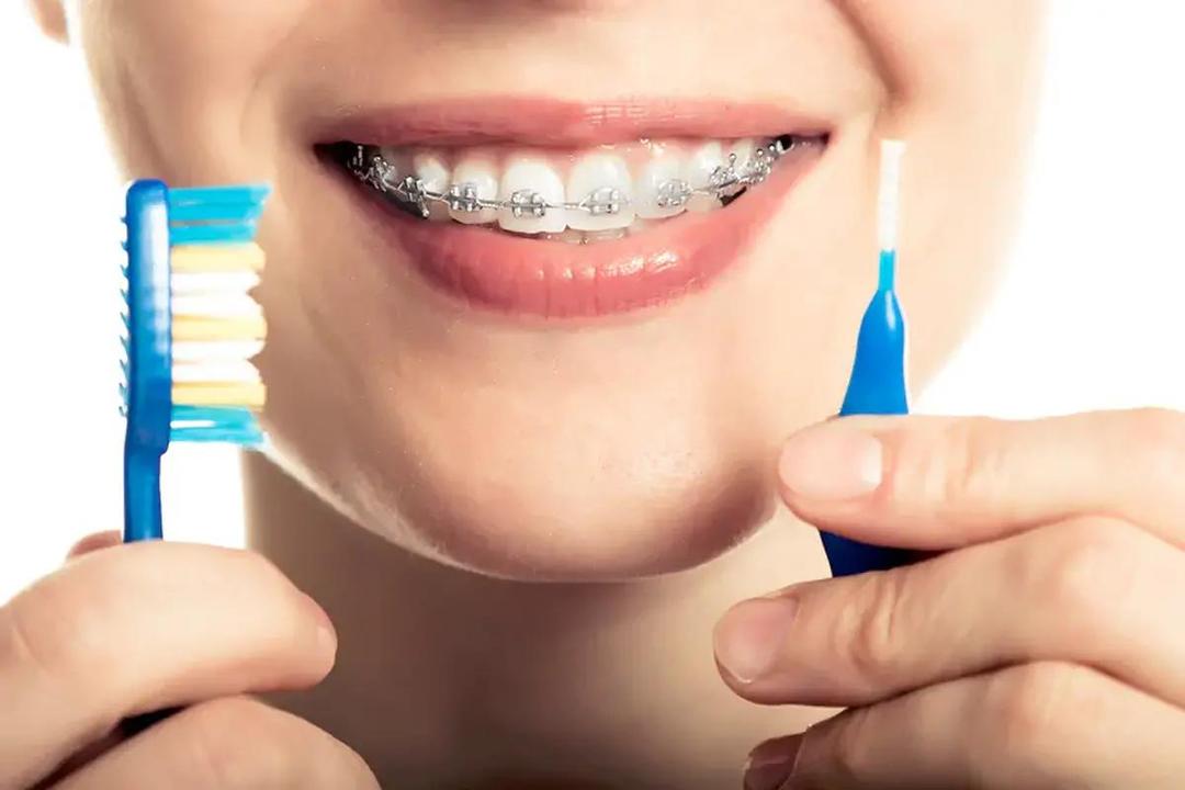 چرا بیماران ارتودنسی باید مراقبت از بهداشت دهان را جدی بگیرند؟