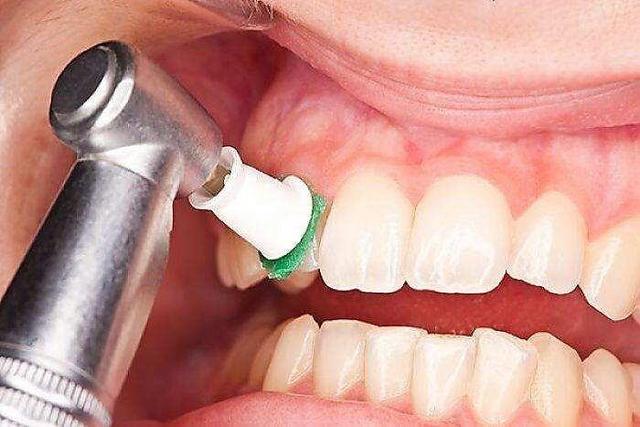 کلید پیشگیری از تشکیل جرم دندان ؛ چرا جرم دندان ایجاد می‌شود ؟