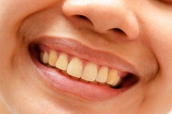 راهکاری برای پیشگیری از تشکیل جرم دندان
