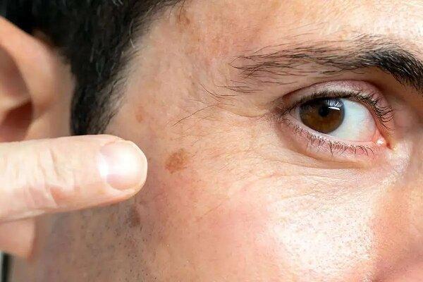 راه‌های درمان انواع لک‌های پوستی