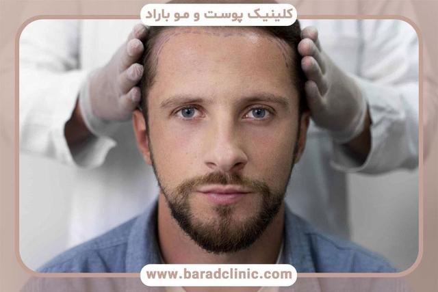 چگونه کاشت مو می‌تواند چهره را جوان کند؟
