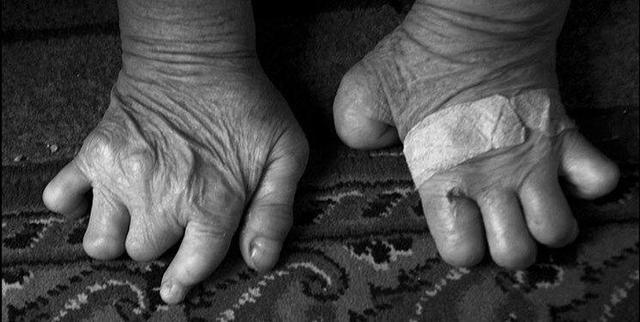 تاریخ حمایت از جذامیان در آستان‌ قدس رضوی