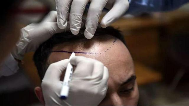 رادیو ملی آمریکا: ترکیه به پایتخت کاشت موی جهان تبدیل شده است