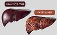 کبد چرب؛ بیماری خاموش اما قابل درمان