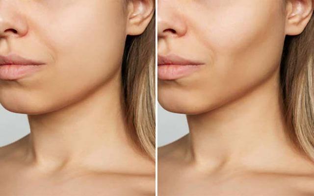 لیپوفیس (سوپر کانتور، غبغب و بوکال)