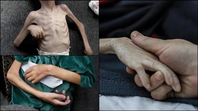 شهادت ۴۲۱ نفر در غزه طی سال ۲۰۲۵ به علت سوءتغذیه