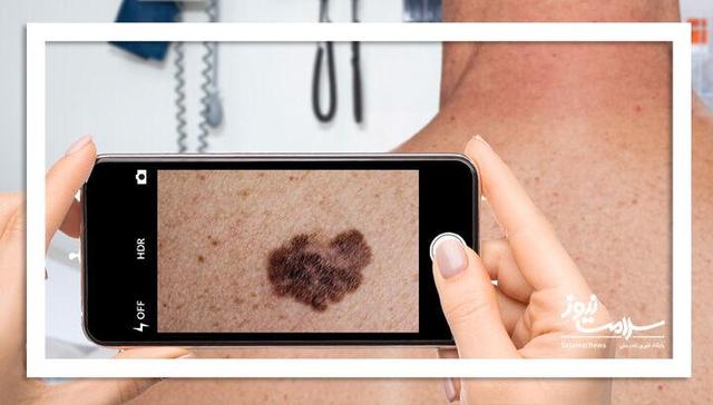 ویزیت پوست با یک عکس/آینده تله‌درماتولوژی در کشور