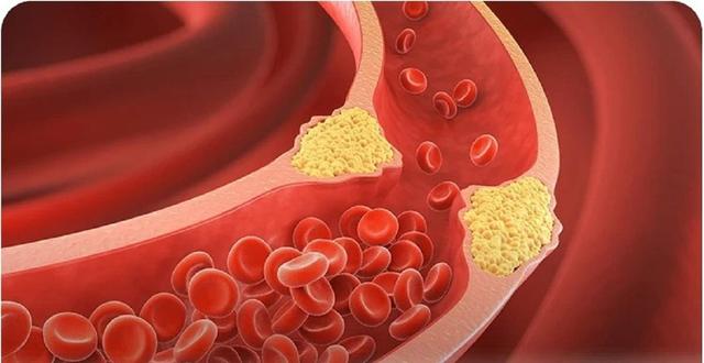 برای کاهش سریع چربی خون چه بخوریم؟ [۱۹ خوراکی شفابخش]