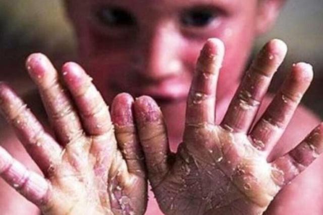 پانسمان حیاتی بیماران پروانه‌ای در فهرست تحریم‌هاست