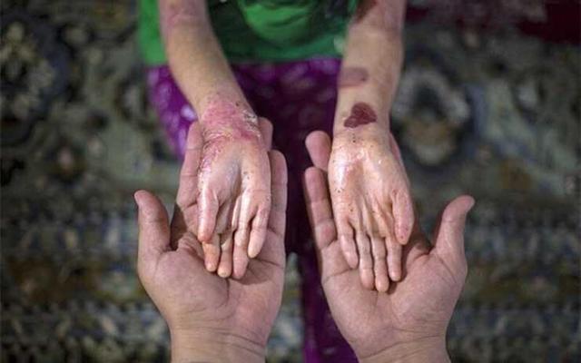 با خروج آمریکا از برجام، فوت مبتلایان به ‌ای‌بی به‌دلیل نداشتن پانسمان/ برخی مدارس از ثبت‌نام این دانش‌آموزان خودداری می‌کنند