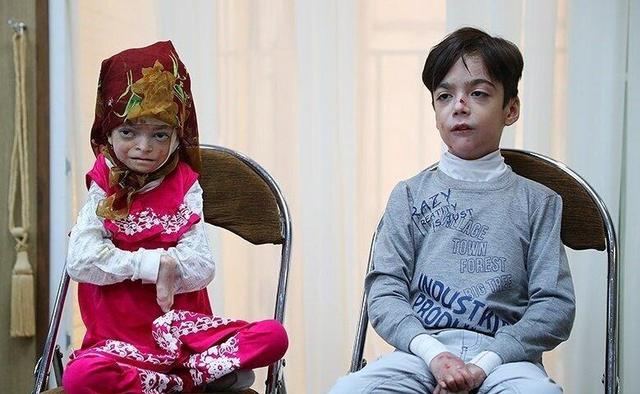 ۹۵ درصد بیماران پروانه‌ای حاصل ازدواج فامیلی هستند | این بچه‌ها را در خیلی از مدارس ثبت‌نام نمی‌کنند