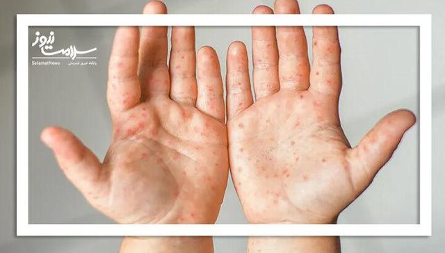 واکسن داخلی تب برفکی به زودی توزیع می شود