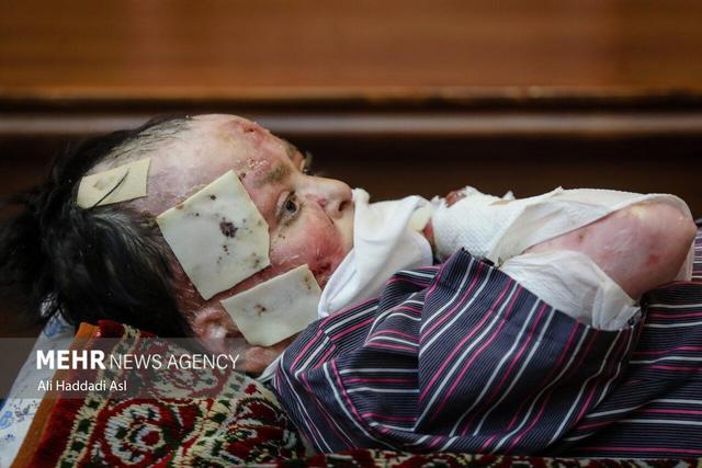 خانواده‌های دارای ازدواج فامیلی بیشتر به بیماری پروانه‌ای مبتلامی‌شوند