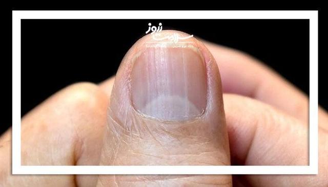 حقایقی درباره هاله ناخن‌ها