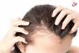 چهار توصیه مهم برای کسانی که ریزش مو دارند