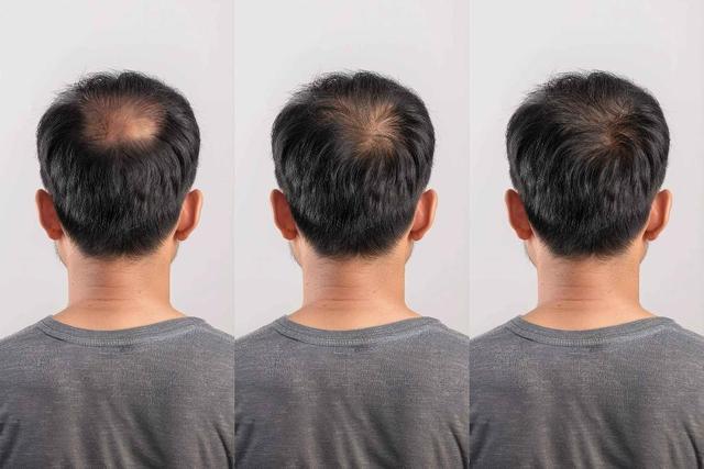 چهار راهکار ساده برای جلوگیری از ریزش مو