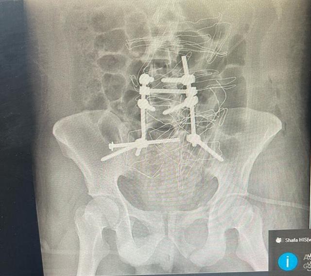 جراحی موفق اتصال مجدد ستون فقرات به لگن در پارس‌آباد