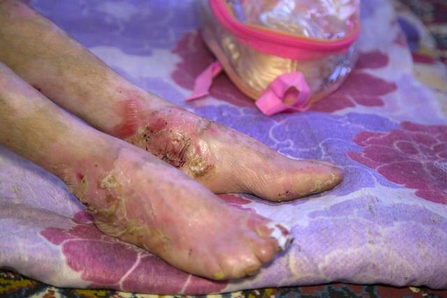 ۱۰۰ خانواده در ایران حداقل ۲ فرزند مبتلا به ای‌بی دارند | بیماران پروانه‌ای چند سال عمر می‌کنند؟