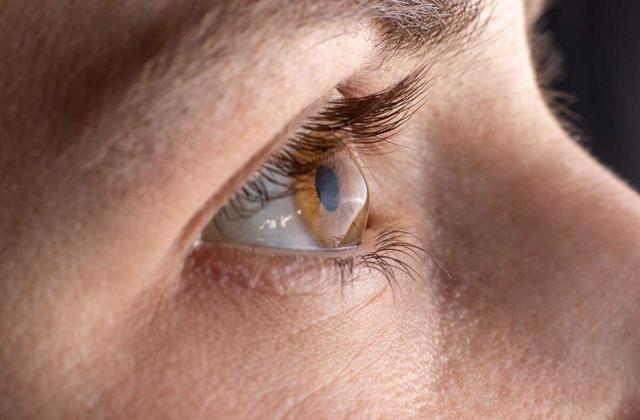 شیوع قوز قرنیه در ایران بالاتر از جهان/چه عواملی سبب بروز بیماری می‌شود؟