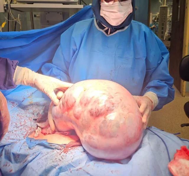 خارج‌ کردن توده ۱۰ کیلویی از شکم یک بیمار در کرج