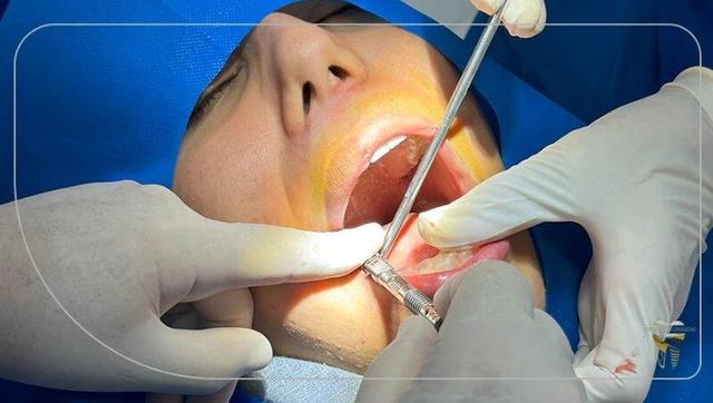 فناوری های به کار برده شده در ایمپلنت دیجیتال ۲۰۲۶