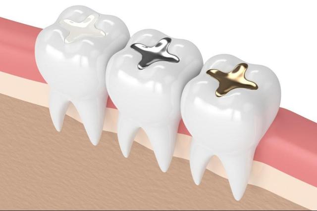 پرکردن دندان با جیوه منسوخ می شود