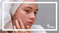 ۵ ترفند مراقبت از پوست برای مقابله با آکنه در فصل سرما