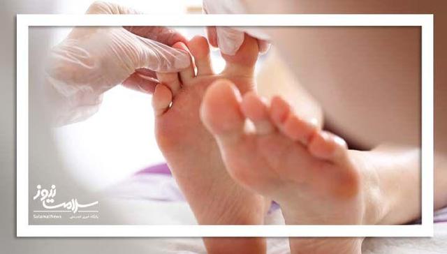 ۱۵ درصد دیابتی‌ها به زخم دیابت مبتلا می‌شوند؛ خطرات و راه‌های پیشگیری