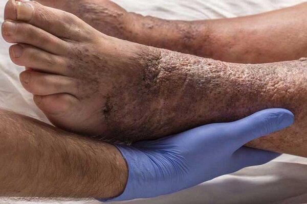 ۱۵ درصد دیابتی‌ها دچار زخم دیابتی می‌شوند