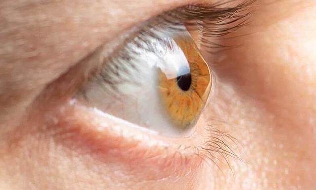 چرا تشخیص زودهنگام قوز قرنیه مهم است؟(اینفوگرافی)