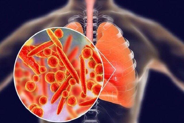 پنومونی؛ همچنان بزرگ‌ترین قاتل عفونی جهان / ضرورت تقویت واکسیناسیون جهت مهار مرگ‌ومیر ذات‌الریه