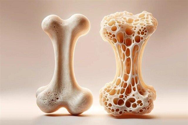 تقویت استخوانها با مصرف این ویتامینها