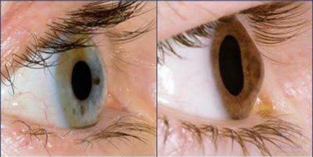 آیا استفاده مداوم از موبایل و لپتاپ باعث قوز قرنیه میشود؟