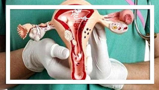 روایت زنانی که با آندومتریوز یک بیماری آزاردهنده درگیرند