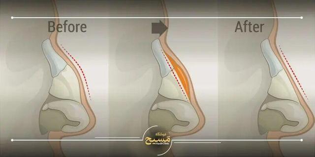 قیمت تیپ پلاستی بینی در تهران؛ بررسی تخصصی و عوامل تأثیرگذار