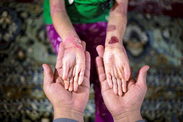 دولتی: مشاوره ژنتیک از تولد نوزادان بیمار پیشگیری می‌کند