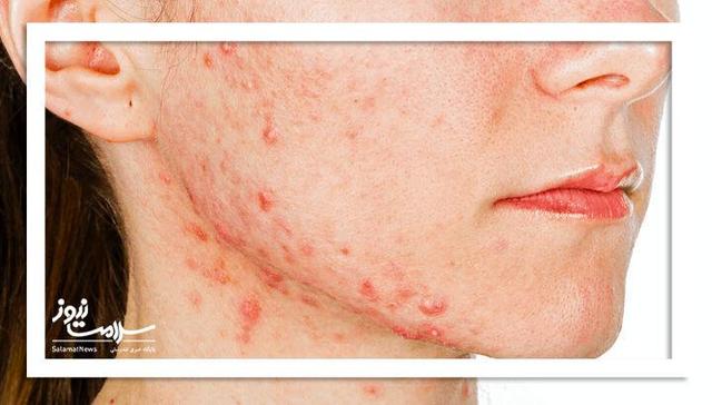 ۷ نشانه مهم که میگوید PCOS شما در حال بدتر شدن است