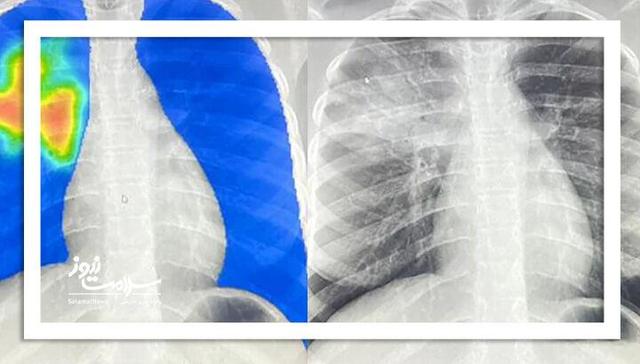 موارد ابتلا به سل در جهان به بالاترین سطح تاریخی رسید؛ ۸.۳ میلیون نفر مبتلا در ۲۰۲۴"