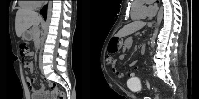 چربی احشایی چه اثری بر سلامت شما می‌گذارد؟