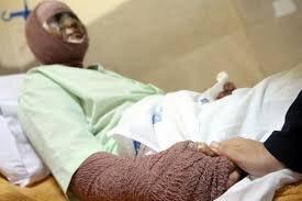 دیگِ رب، قاتل زن گلستانی شد | او دچار سوختگی ۸۰درصدی شده بود