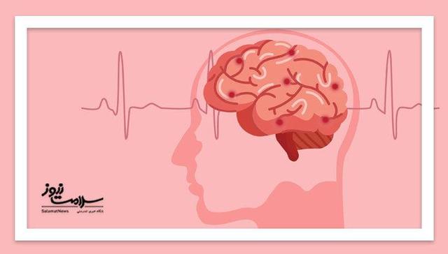 سکته مغزی دومین عامل مرگ‌ومیر در جهان؛ ۸۰ درصد سکته‌ها قابل پیشگیری است