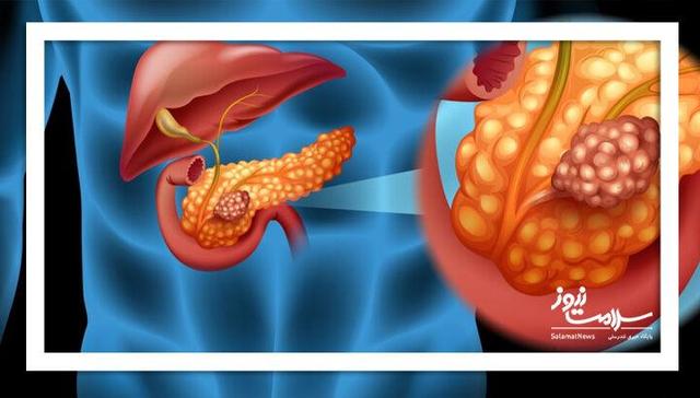 شناسایی علامت هشدار دهنده اولیه سرطان پانکراس، معروف به «قاتل خاموش